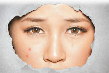 拒當(dāng)「痘花妹」！看痘痘生長(zhǎng)的位置判斷也許是身體出了問(wèn)題